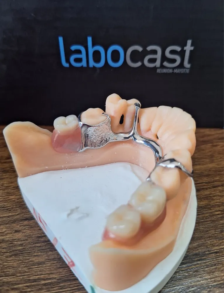 Partial denture with metal framework