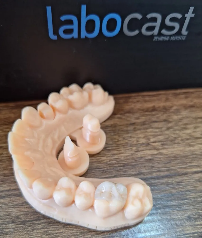 Lower partial denture with clasps